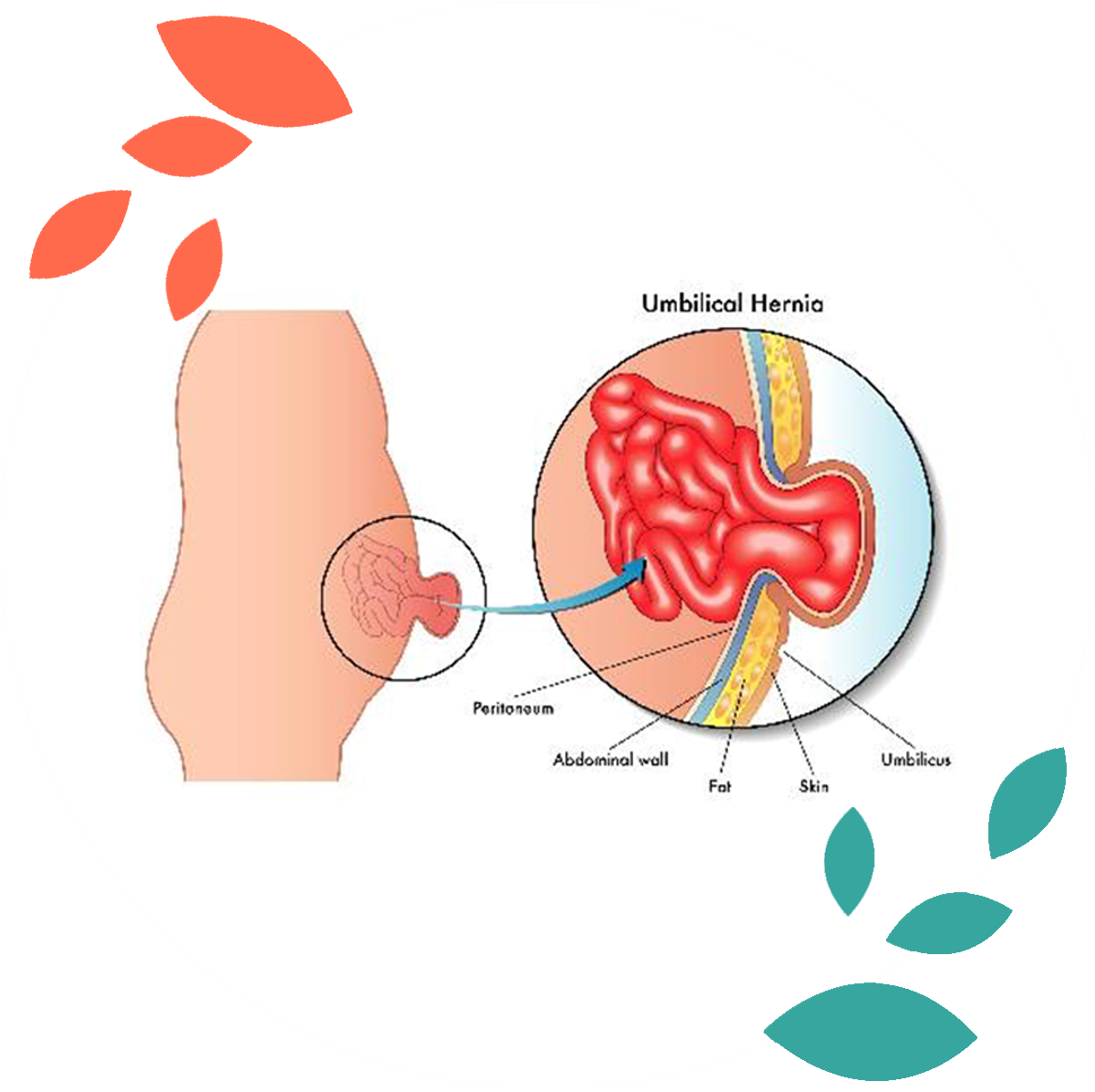 hernia treatment in delhi noida