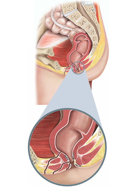 anal fistula surgeon delhi noida