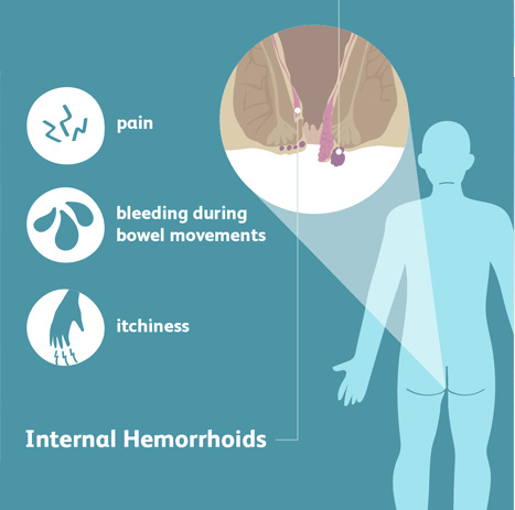 hemorrhoids treatment delhi noida