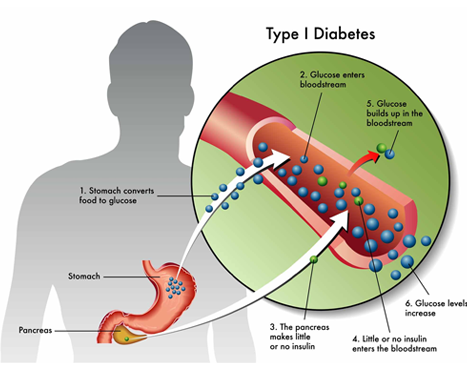 diabetes mellitus treatment in delhi noida