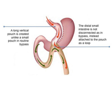 mini gastric bypass surgeon in delhi noida