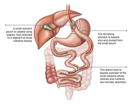 gastric bypass surgery 