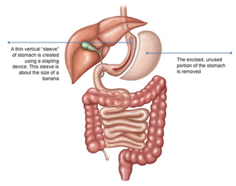 sleeve gastrectomy treatment in delhi noida