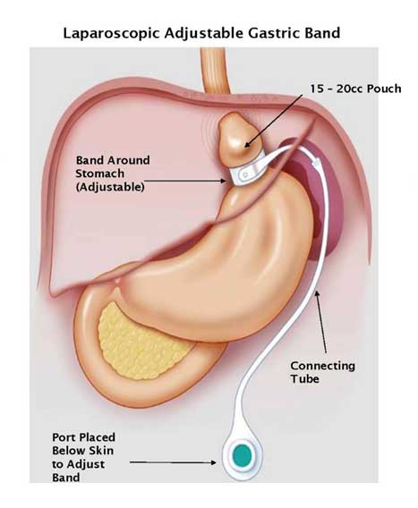 gastric banding treatment in delhi noida