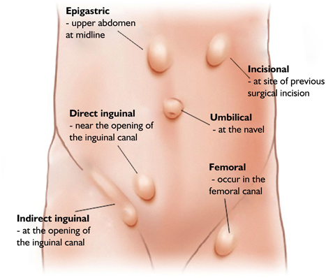 hernia doctor in delhi noida