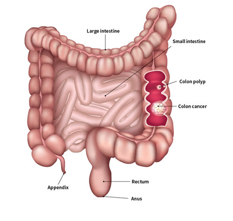 colon cancer doctor in delhi noida