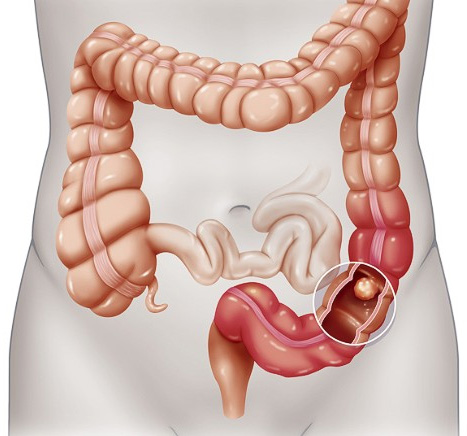 cancer rectum treatment in delhi noida