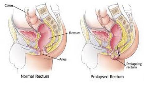 rectal prolapse surgery clinic in delhi noida